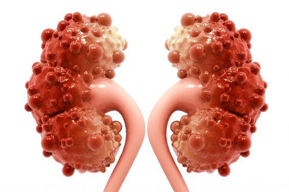 Polycystic kidney disease PKD transplant renal St. Paul's