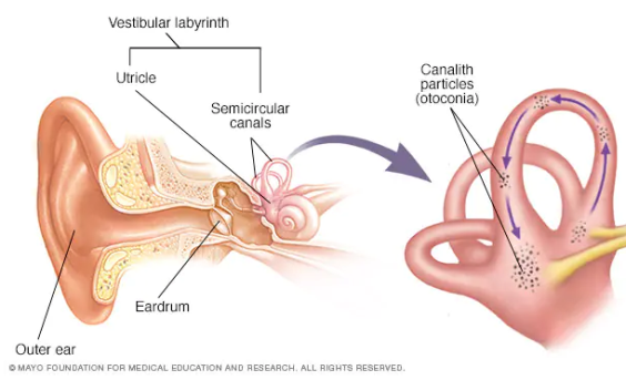 To indicate the condition of benign paroxysmal positional vertigo BPPV.