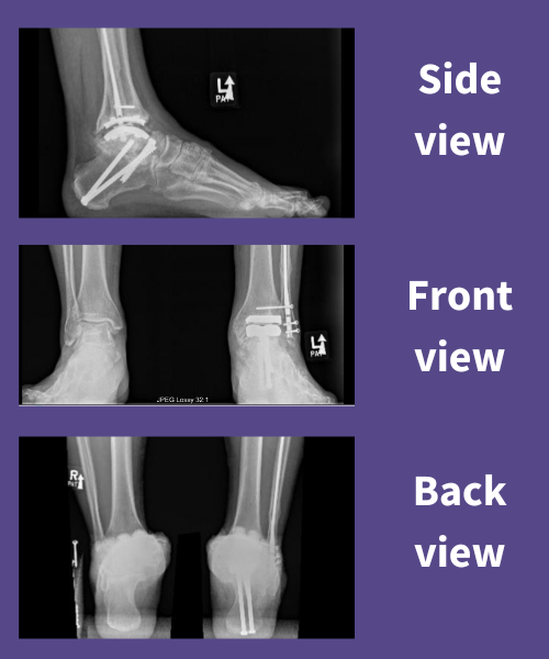 6 Signs of an Ankle Fracture: Chicagoland Foot and Ankle: Board Certified  Foot and Ankle Specialists and Surgeons